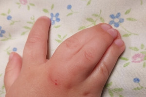 Во Владимире врачи помогши малышу со сросшимися пальцами на руках