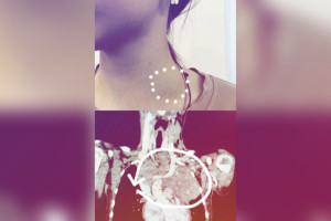 Во Владимире врачи нашли редкое заболевание у 16-летней девочки