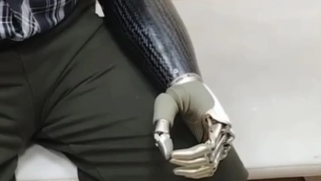 Лишившемуся руки на производстве жителю Владимира установили протез за 3,3 млн рублей