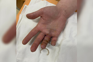 В Коврове освободили сломанный палец от обручального кольца