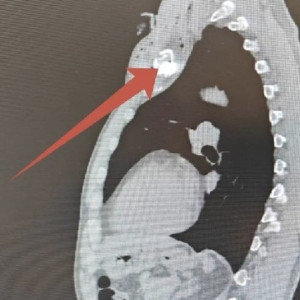 Врачи показали фото осколка в ключице пострадавшего от атаки БПЛА жителя Владимира