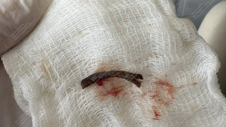 Владимирские врачи удалили из бронхов мужчины куриную кость