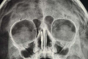 Владимирские врачи извлекли скрепку из носа 4-летнего малыша