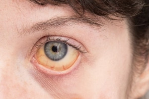 Во Владимирской области 11-летний мальчик заболел гепатитом А