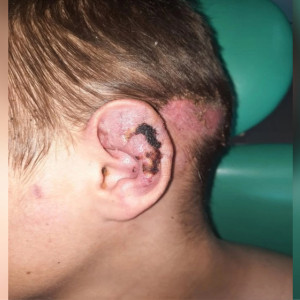 Владимирские врачи спасли ухо сбитому машиной 13-летнему мальчику