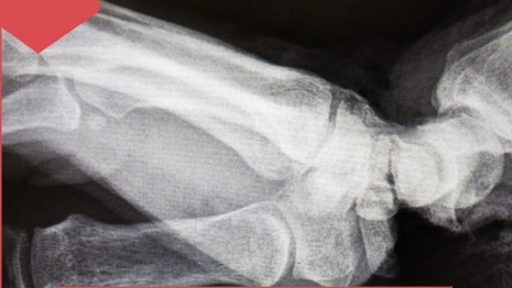 Во Владимире спасли женщину с отрезанной кистью