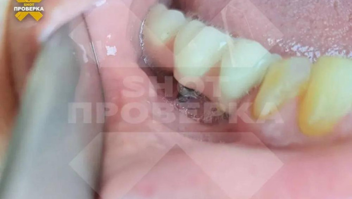 Изуродованная стоматологией женщина отсудила 3 млн рублей во Владимире