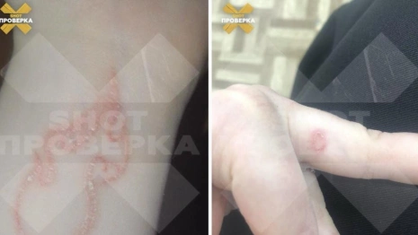 Две подружки из Владимира получили срезанную кожу и шрамы вместо тату