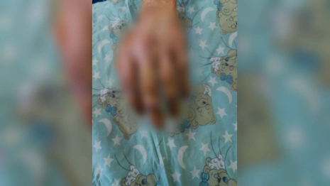 Владимирские врачи спасли поврежденную во время ремонта питбайка руку подростка