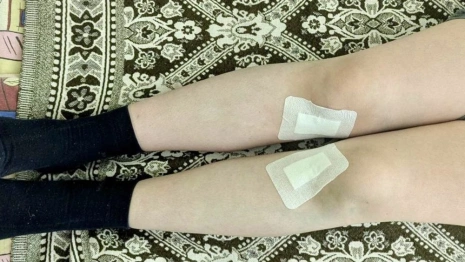 Владимирские врачи исправили х-образную деформацию ног подростку