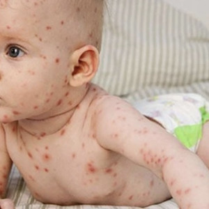 Владимирские врачи спасли 11-месячного ребенка с ветряной оспой