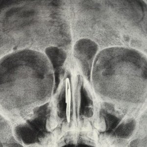 Владимирские врачи извлекли скрепку из носа 4-летнего малыша