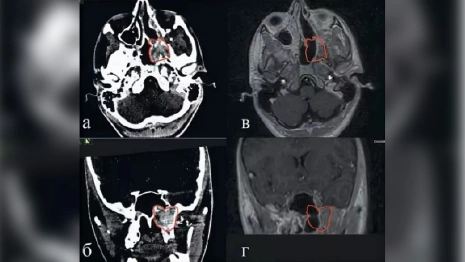 Во Владимире у 15-летнего подростка выявили ангиофиброму черепа