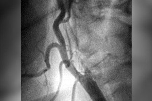 Во Владимире врачи спасли девочку с бактериальным менингитом
