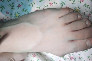 Во Владимире прооперировали 14-летнюю пациентку с болезнью Халлюкс Вальгус