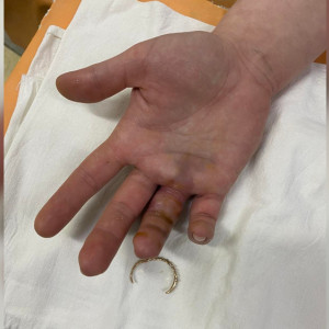 В Коврове освободили сломанный палец от обручального кольца