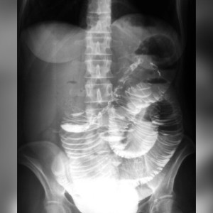 Во Владимире врачи ОДКБ спасли подростка с патологией младенцев