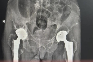 В Коврове медики освоили передовые методы лечения переломов тазобедренного сустава