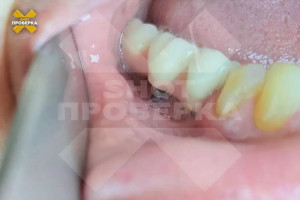 Изуродованная стоматологией женщина отсудила 3 млн рублей во Владимире