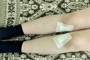 Владимирские врачи исправили х-образную деформацию ног подростку