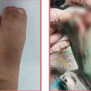 Владимирские врачи спасли 4-летнего малыша с тремя сросшимися пальцами на ноге