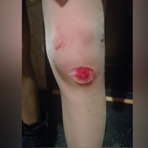 В Александрове школьница разбила ногу на скользкой дороге 