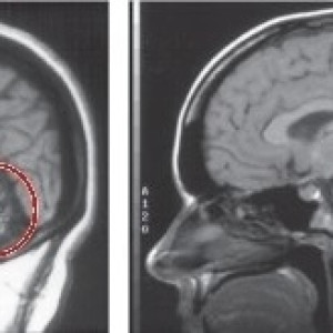 В ОДКБ Владимира пациентке поставили редкий диагноз
