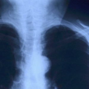 Во владимирском роддоме малышу сломали плечо