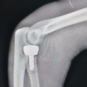 В Александровской больнице впервые поставили эндопротез локтевого сустава пациенту