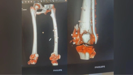 Владимирские врачи поставят на ноги 15-летнюю девочку после ДТП с мотоциклом