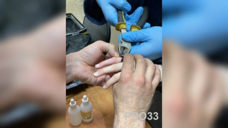 Во Владимире у 12-летнего мальчика палец застрял в кольце