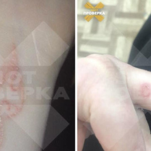 Две подружки из Владимира получили срезанную кожу и шрамы вместо тату