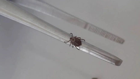 Во Владимирской области с людей сняли 2 зараженных болезнью Лайма клещей