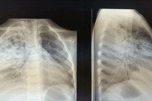 Во Владимире медики спасли малыша со скоплением гноя в легких