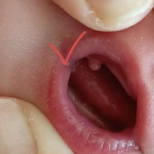 Владимирские врачи удалили новорожденному малышу опухоль во рту