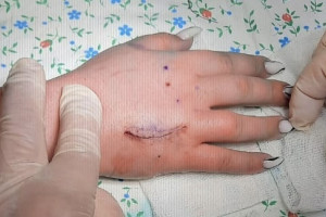 Во Владимире прооперировали 17-летнюю девушку с коротким безымянным пальцем