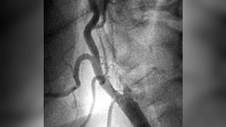 Во Владимире врачи спасли девочку с бактериальным менингитом