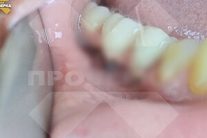 История с изуродованием челюсти жительнице Владимира в стоматологии дошла до главы СК
