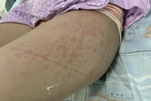 Из Владимира на вертолете эвакуировали 10-летнюю девочку с юношеским артритом