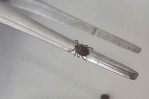 Во Владимирской области с людей сняли 4 зараженных болезнью Лайма клещей