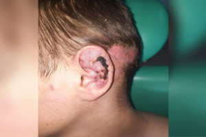 Владимирские врачи спасли ухо сбитому машиной 13-летнему мальчику