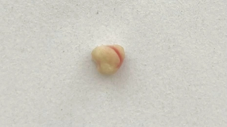 Владимирские врачи удалили камень из протока слюной железы ребенка