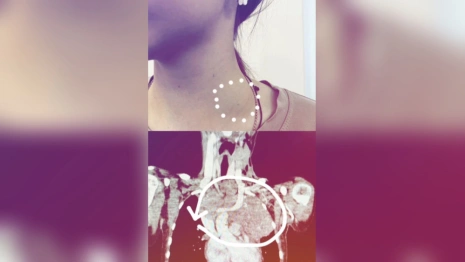 Во Владимире врачи нашли редкое заболевание у 16-летней девочки