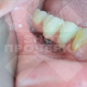 Изуродованная стоматологией женщина отсудила 3 млн рублей во Владимире