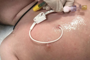 Во Владимире внедрили постановку долгосрочного сосудистого доступа онкобольным детям