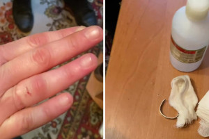 В Коврове спасатели помогли вызволить палец женщины из кольца