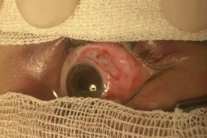 Владимирские врачи спасли 8-летнюю девочку после падения на нее ледяной глыбы