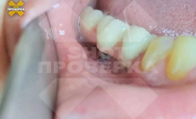 Изуродованная стоматологией женщина отсудила 3 млн рублей во Владимире