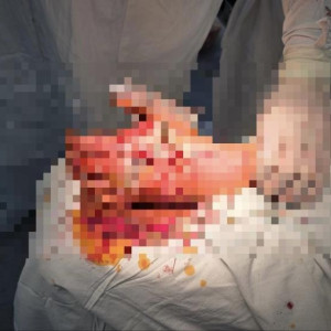 Владимирские врачи провели уникальную операцию пострадавшему от взрыва петарды ребенку