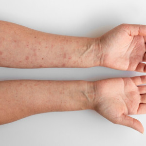 В Гусь-Хрустальном доме ребенка дети заболели корью